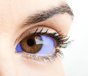 As shown in this artist's impression, methylene blue stains the whites of the eyes blue. That could cause problems testing the drug because of the placebo effect.  