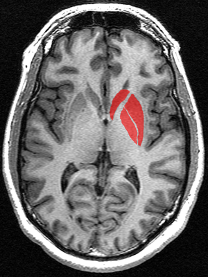 The basal ganglia (in red) are a set of structures deep under the surface of the brain. These brain regions have long been known to suffer the most damage in the course of HD. 