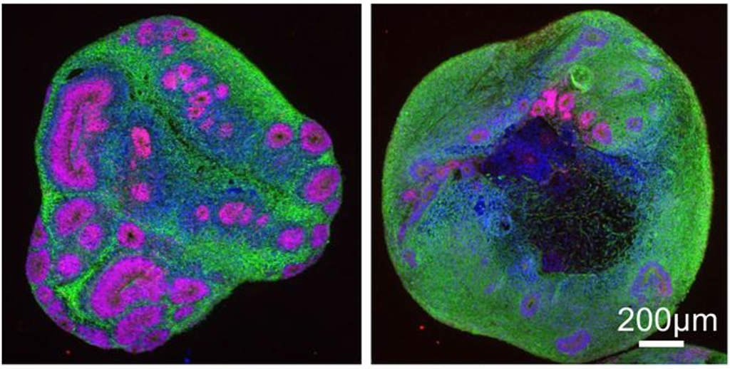 Recent advancements have allowed scientists to grow neurons in 3D, modeling a minibrain. In this study, juvenile-onset HD minibrains (right) were found to have fewer and smaller internal structures, shown here in pink, compared to organoids representing someone without HD (left).  