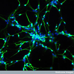 Combining gene therapy with stem cells offers the prospect of treating patients using their own 'repaired' cells - but many challenges remain before it could be used for HD.