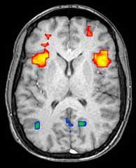 An example of what an fMRI scan looks like - brain regions that are activated at a given time (in red) can be distinguished from those that are less active (in blue). This kind of image helps scientists map which parts of the brain are being used by a person to solve a problem.