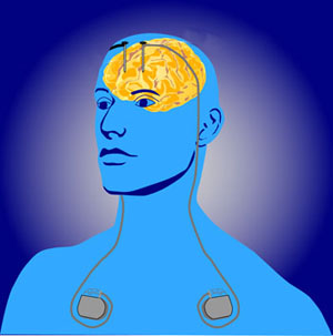 Deep brain stimulation involves thin electrodes placed through the skull into the brain. Pulse generators placed beneath the skin supply electrical impulses to the brain.