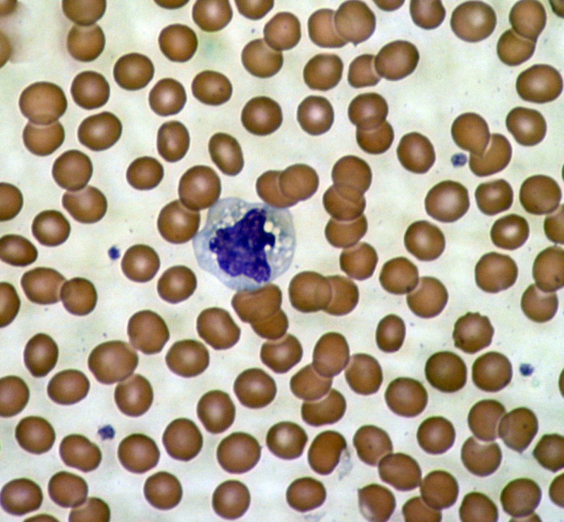 A microscopic image of blood cells - red blood cells surround a single cell of the immune system.