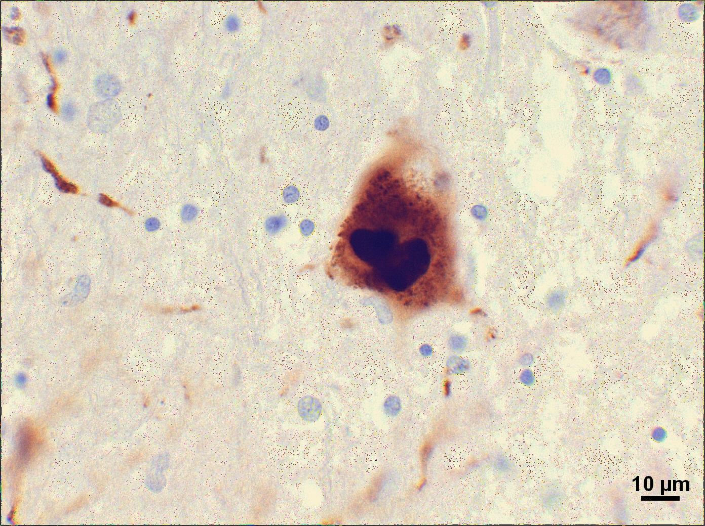 In the brains of Parkinson's disease patients, clumps of proteins called 'Lewy bodies' are found. Recent work suggests that these clumps of junk can also be found in new, young, cells transplanted into the brains of PD patients.
