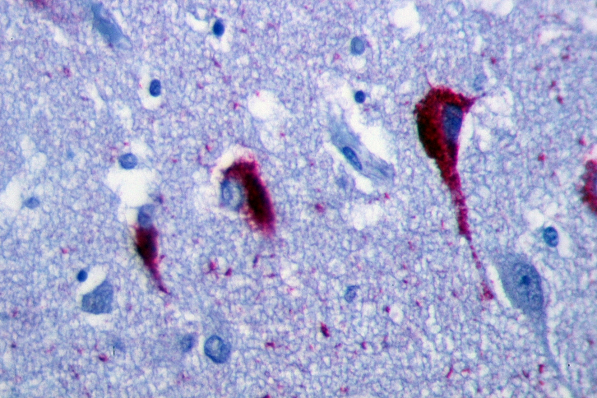 This is what tau protein looks like when it sticks together to form 'neurofibrillary tangles' in the brain of an Alzheimer's disease patient. Tau is named after the Greek letter 'T'.