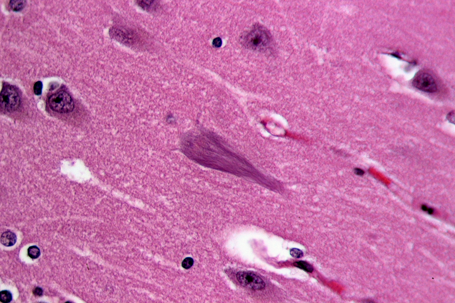 The lines in the brain cell in the middle of this image from an Alzheimer's disease patient brain are made of tangled up tau protein. New work in Alzheimer's suggests tangled up tau can jump from one brain cell to another.