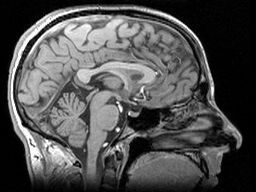 TRACK-HD used powerful MRI scanners to obtain detailed images of volunteers’ brains  