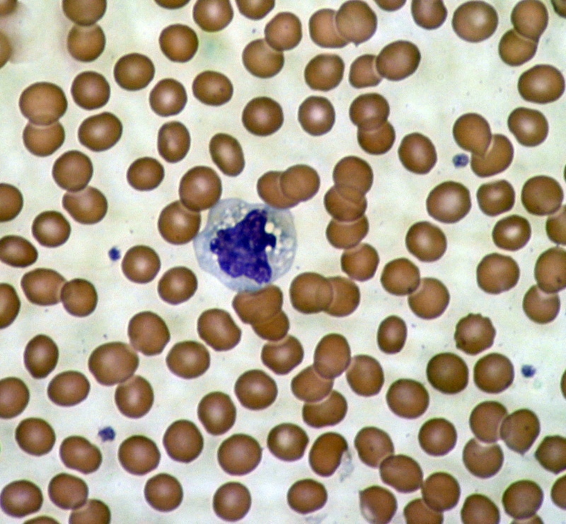 A microscopic image of blood cells - red blood cells surround a single cell of the immune system.  