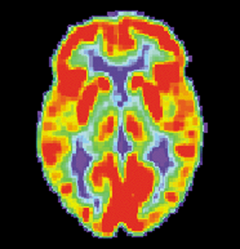 FDG-PET scans enable us to see how much sugar each part of the brain is using. This is a scan of a healthy brain. The red areas are consuming the most sugar.  