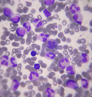 Bone marrow transplantation in Huntington's Disease