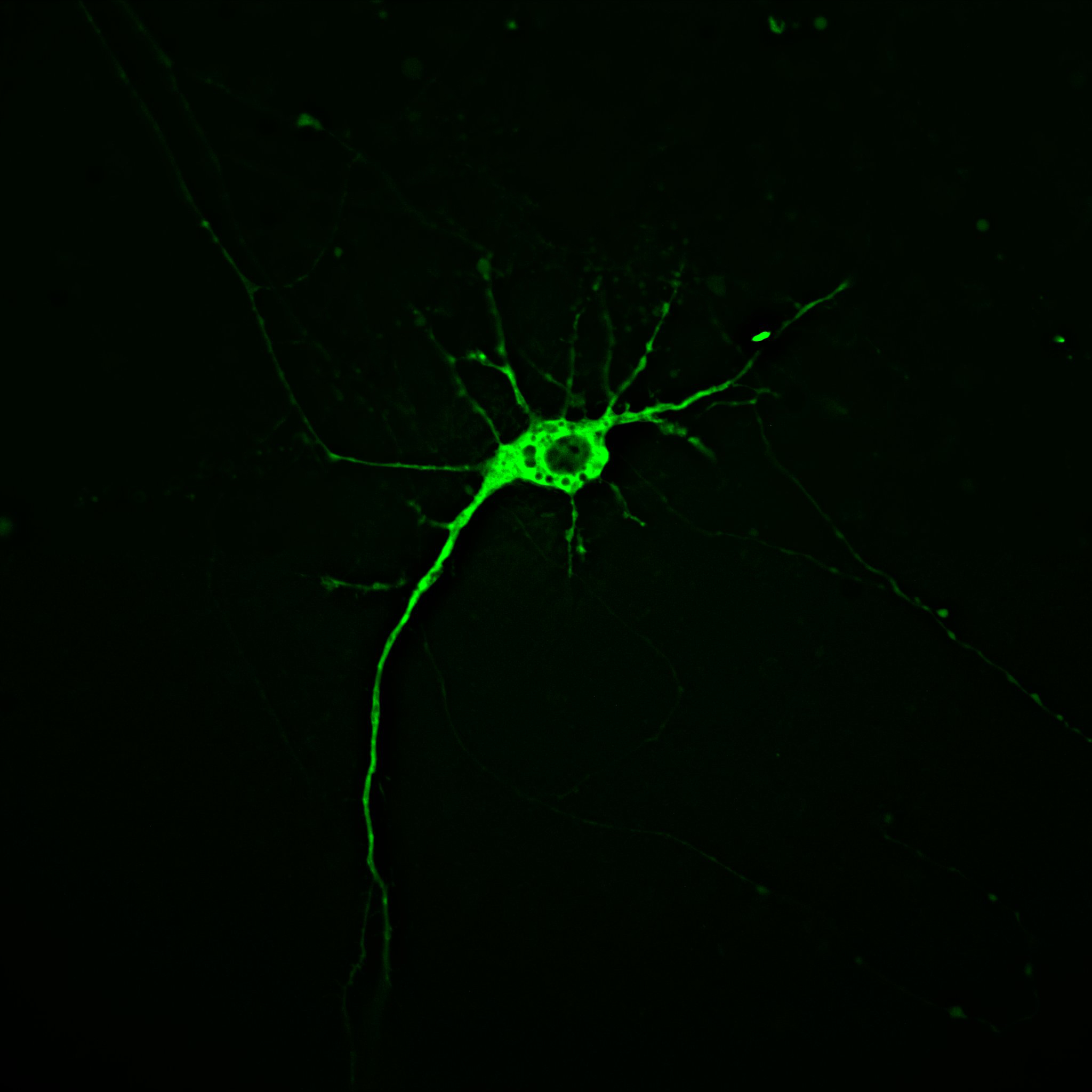 Illuminating the progression of Huntington’s disease