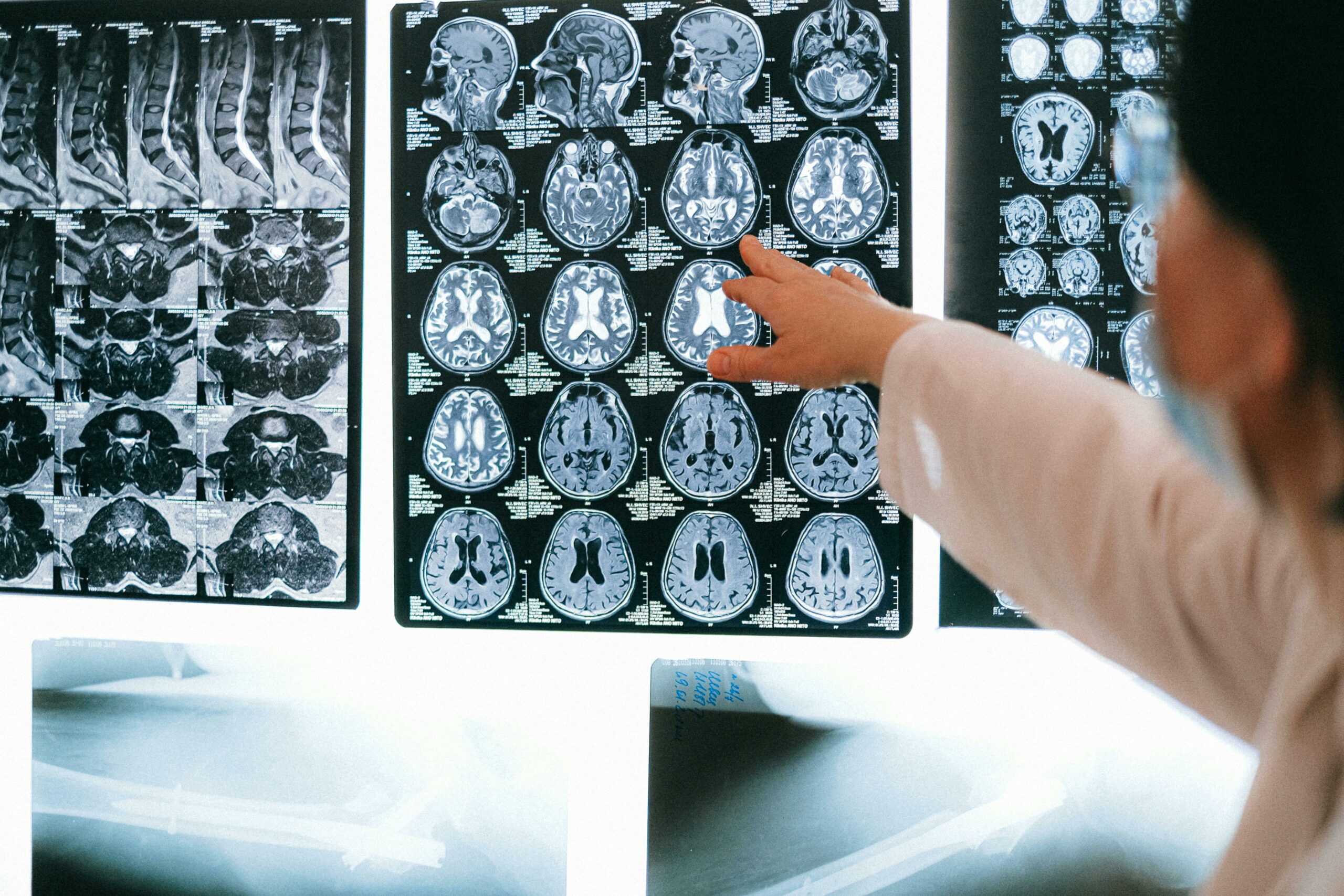 2025 HDBuzz Prize: MR-“why” am I feeling this way? How MRI is helping us understand why people with HD may sometimes be unaware of their symptoms